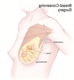 Illustration that explains breast-conserving surgery